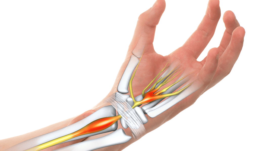 Strategies To Prevent Carpal Tunnel Syndrome Stimulating Wellness